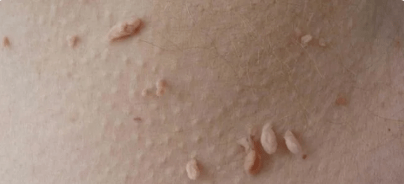 Metodo di trasmissione di HPV