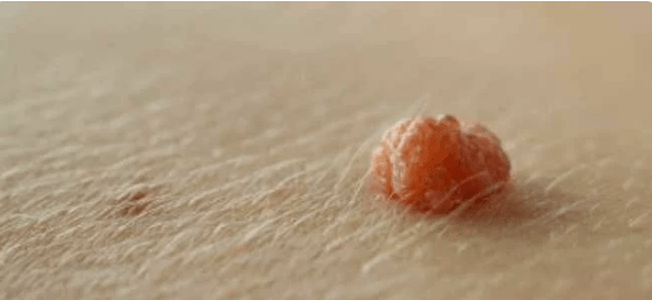Virus del papilloma