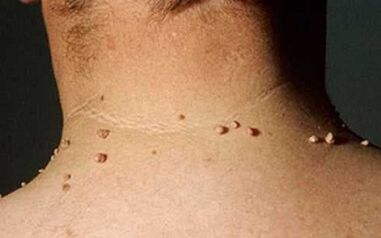 Le ragioni dell'apparizione dei papillomi