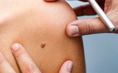 Metodi di trattamento dei papillomi