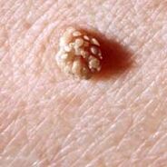 papillomavirus umano sulla pelle