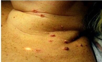 Foto di molti papillomi nelle donne