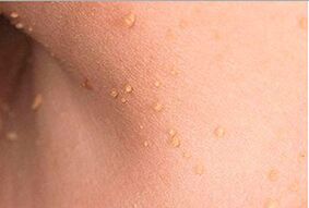Che aspetto hanno i papillomi sul corpo