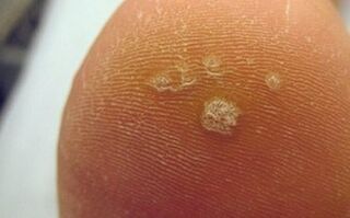 Perché compaiono le verruche plantari