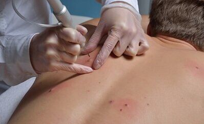 modi per rimuovere i papillomi