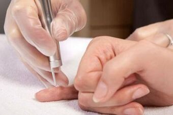 come sbarazzarsi dei papillomi sul corpo