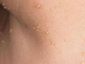 ragioni per la comparsa di papillomi sul corpo