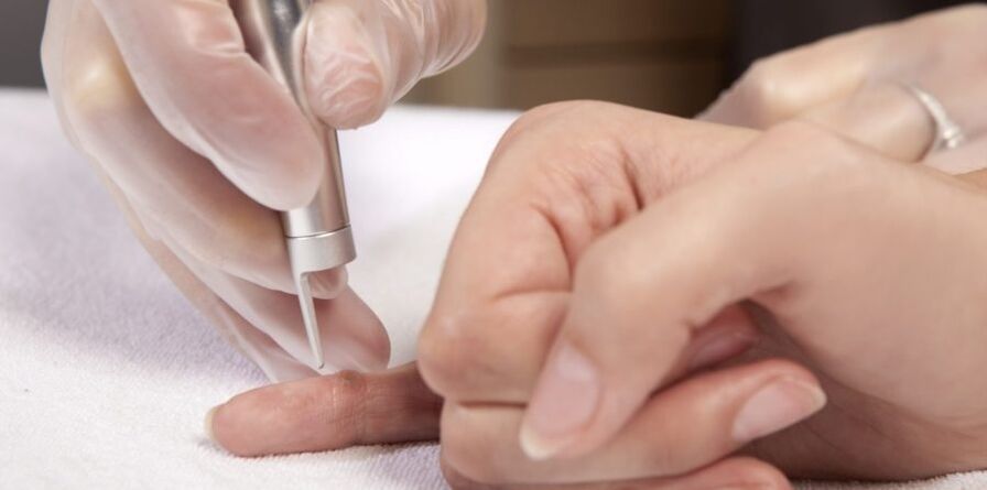 modi per rimuovere i papillomi sulle mani e perché sono pericolosi
