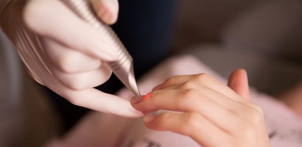 trattamento laser per le verruche