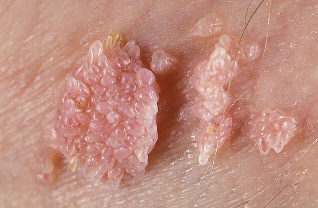 Il papilloma è una formazione benigna simile a un tumore della pelle e delle mucose di natura verrucosa