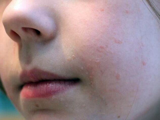 Le verruche piane sul viso compaiono più spesso durante l'adolescenza